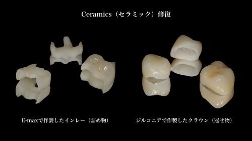 インプラントとセラミック | 本多歯科ブログ | 枚方の歯医者【本多歯科】