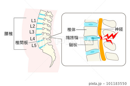 椎間板ヘルニアになった腰椎の説明イラスト拡大図のイラスト素材