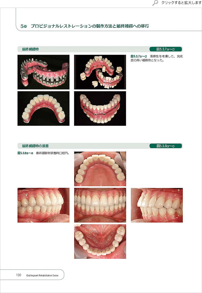 プロビジョナルレストレーション装着期間中の口腔周囲筋トレーニング