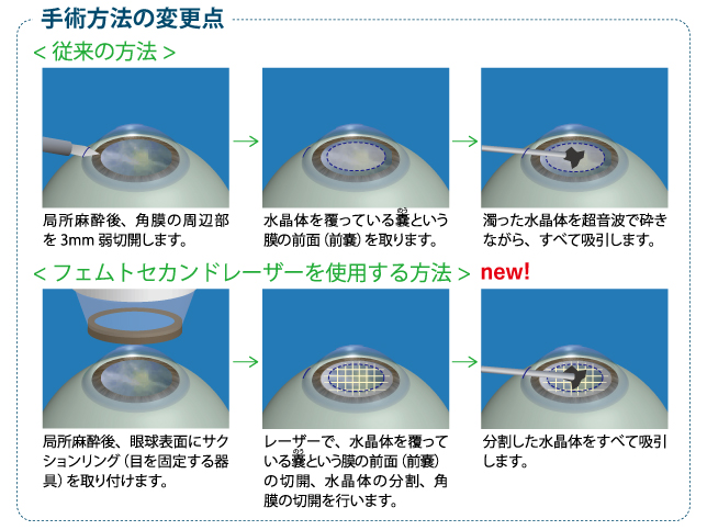 白内障手術｜白内障とは｜レーシックのみなとみらいアイクリニック