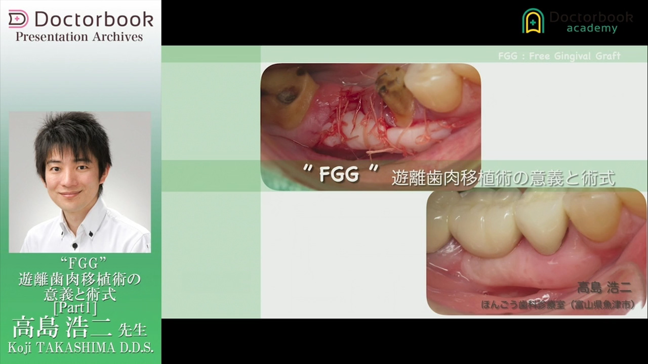FGG/遊離歯肉移植術とは【歯科用語コラム】 | Doctorbook academy
