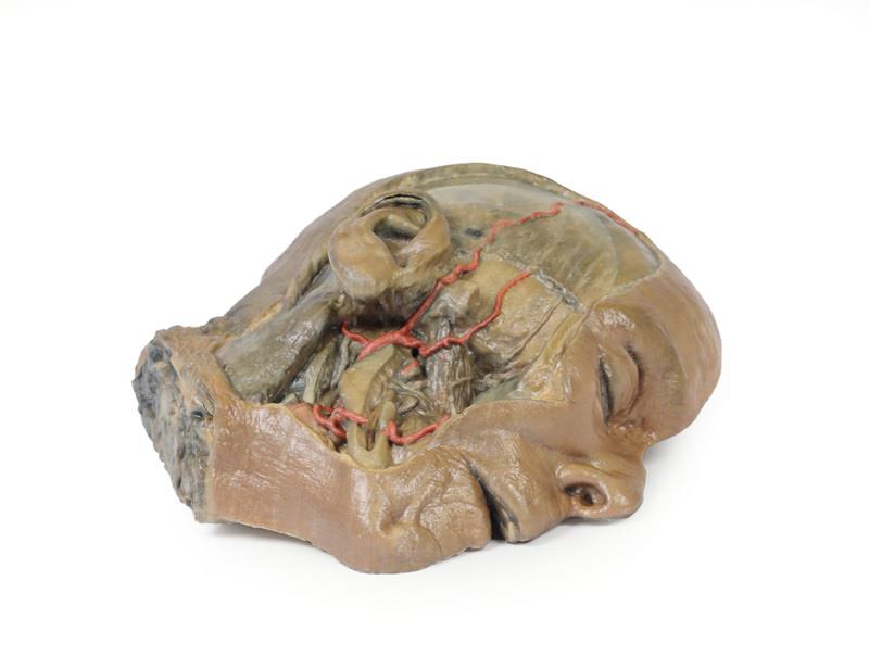 Sagittal Section of head with infratemporal Fossa Dissection | MP1104