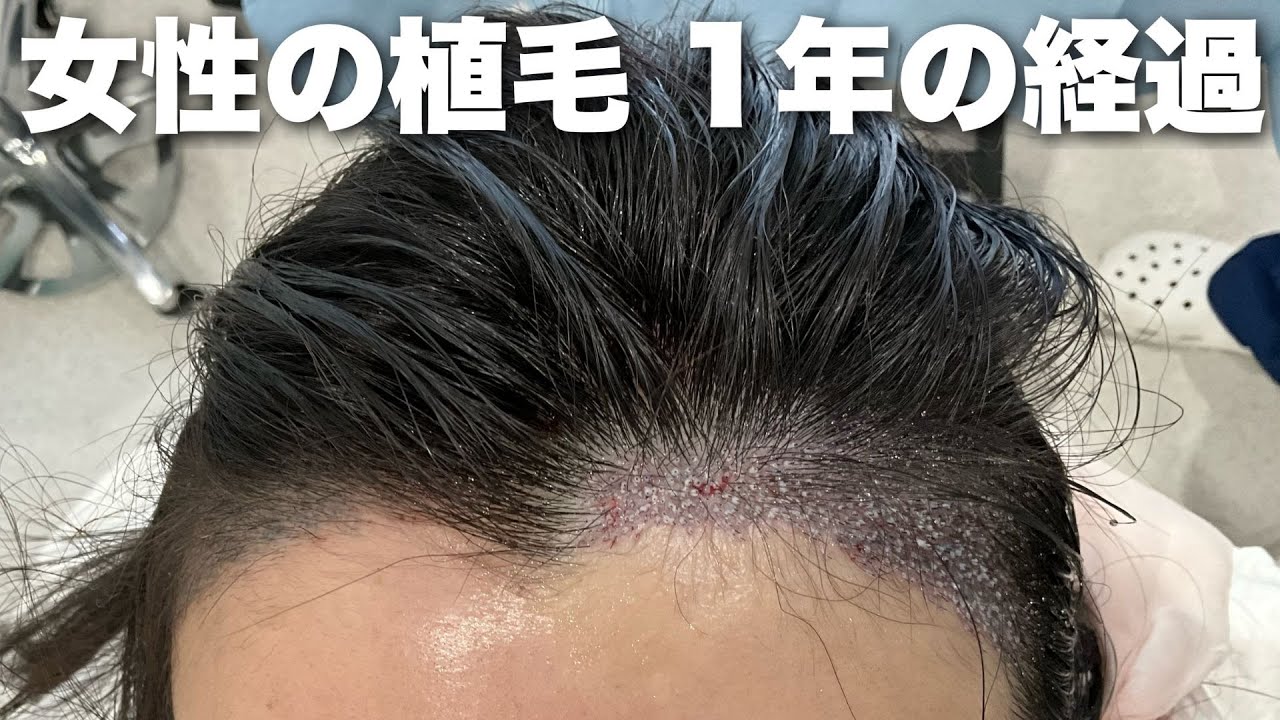 祝完成 女性の植毛 1年の結果 - YouTube
