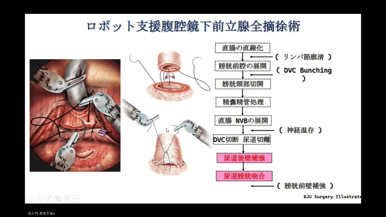前立腺がん治療②手術編】泌尿器の専門医が解説します - YouTube
