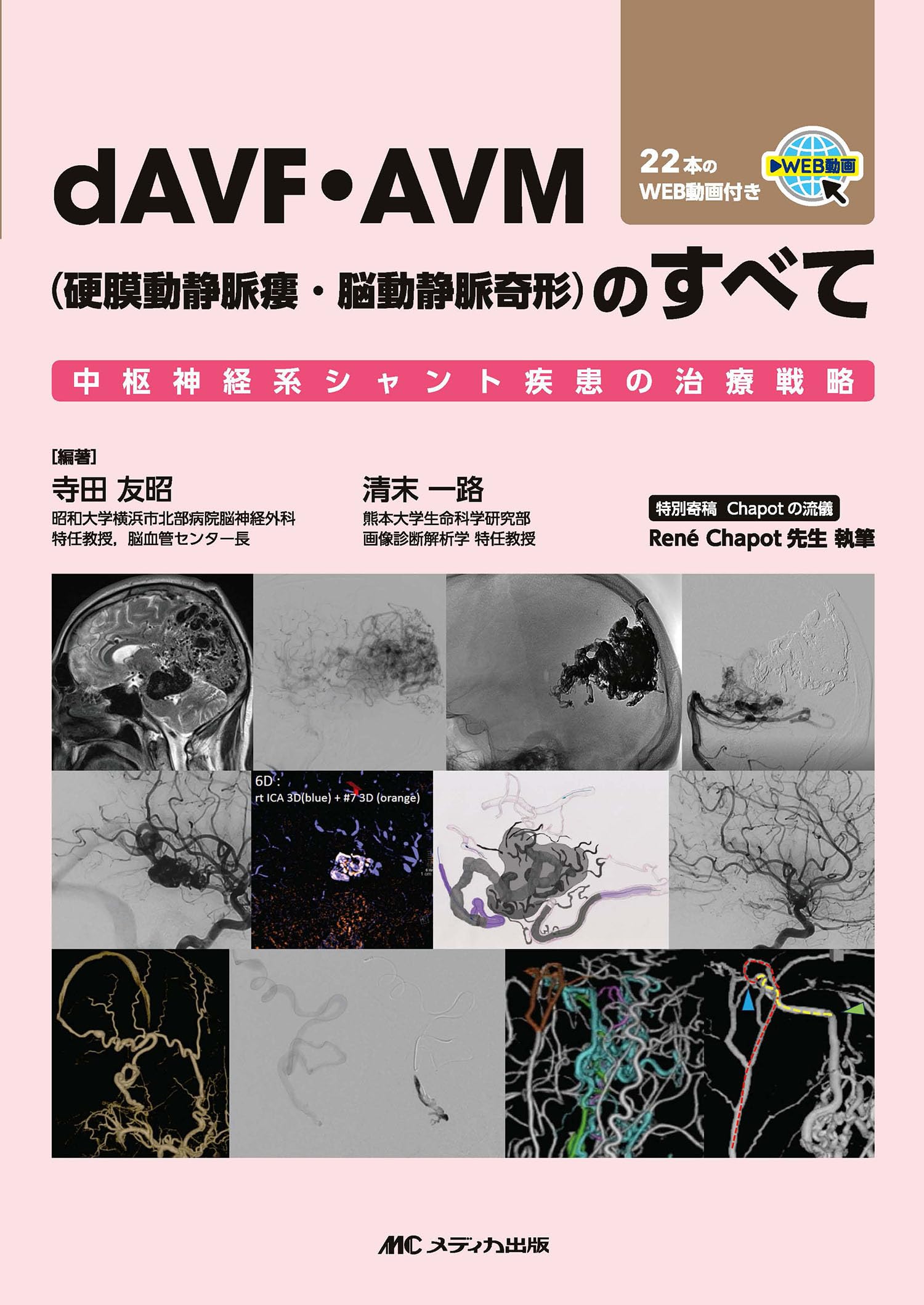 dAVF・AVM（硬膜動静脈瘻・脳動静脈奇形）のすべて：中枢神経系