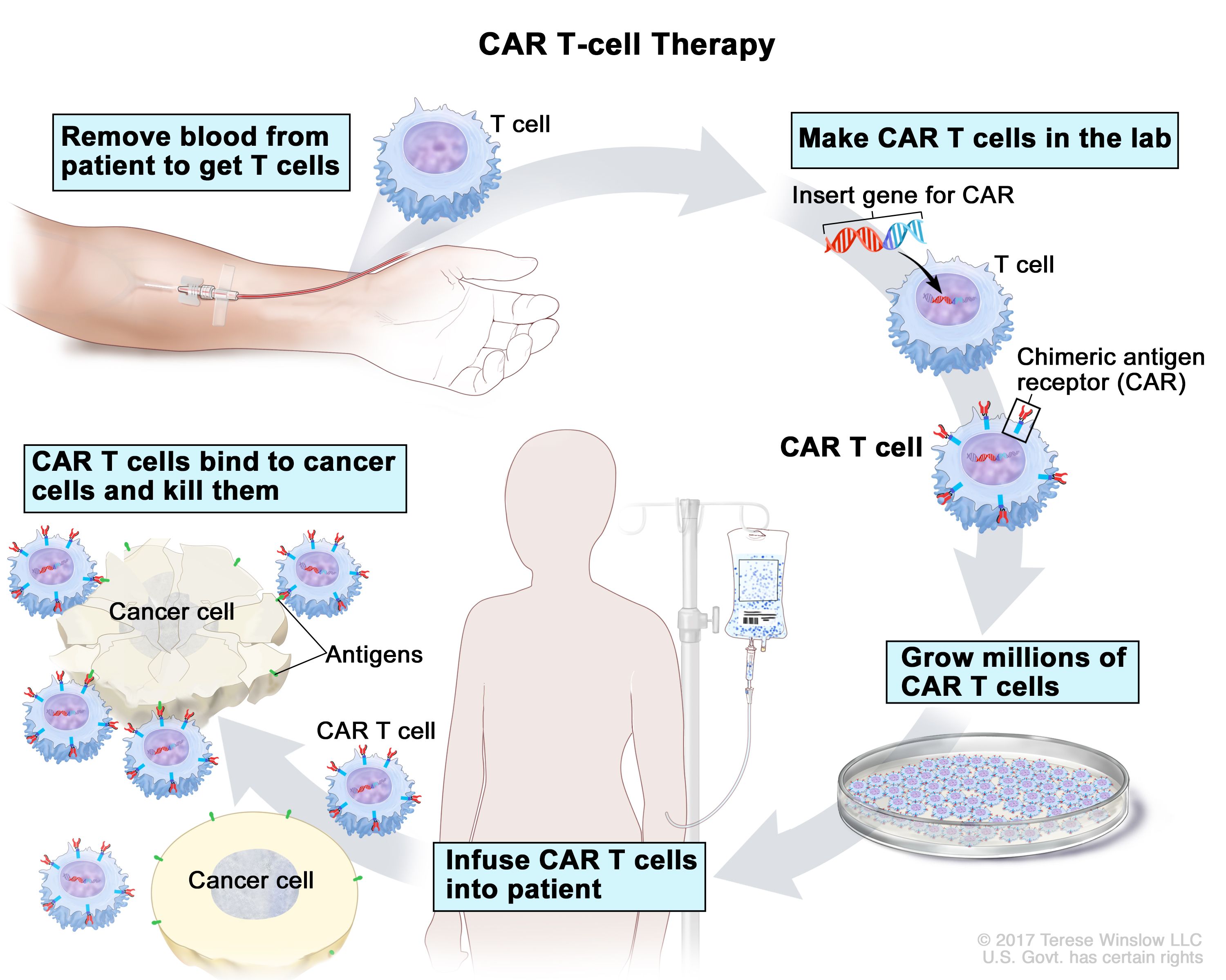 Definition of axicabtagene ciloleucel - NCI Dictionary of Cancer