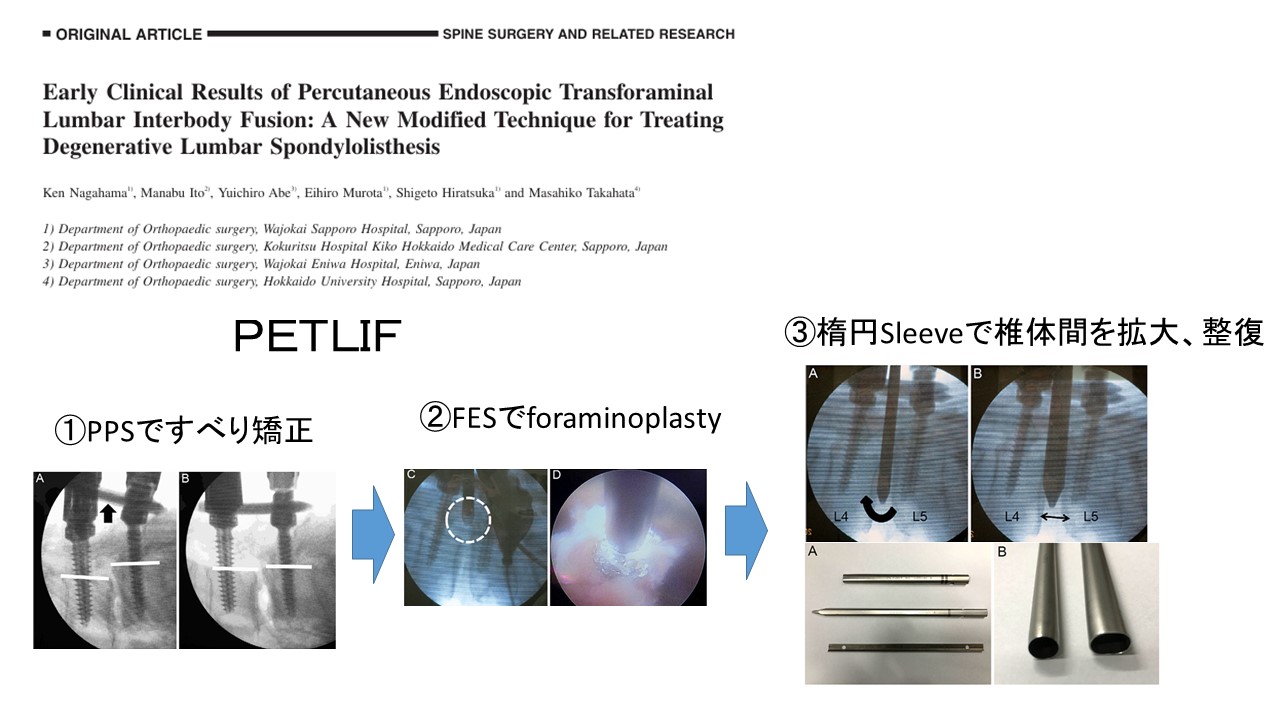 低侵襲脊椎手術PETLIF：短期間で社会復帰を可能にする手術方法 ｜ 成尾