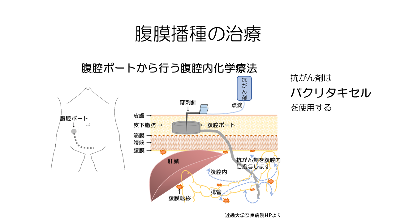 スキルス胃がんの最新治療（胃がん治療完全ガイド） | がんゲノム医療